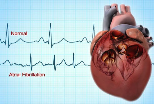 An illustration of a heart with EKG plots shown in the background. The top plot shows a normal heartbeat; the bottom, one with atrial fibrillation.