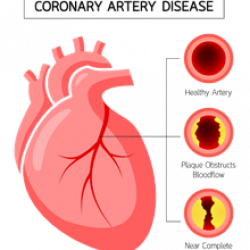 Coronary Artery Disease – NorthStarr Cardiothoracic Surgery