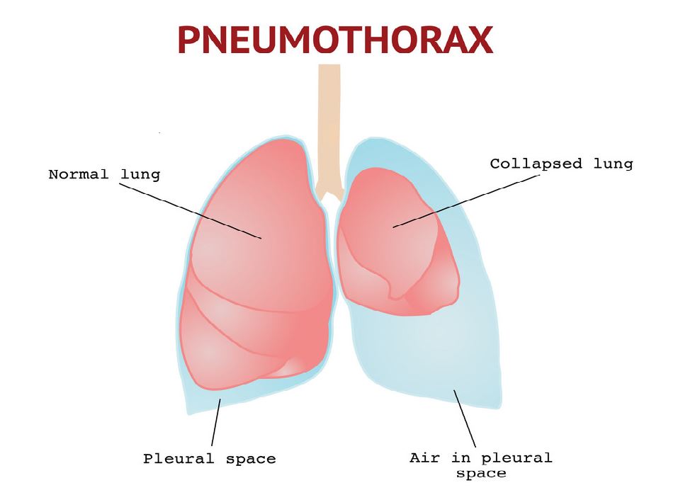 An illustrated diagram showing a normal lung and a collapsed lung.